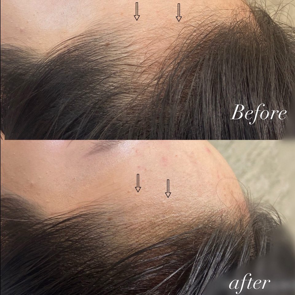 岩谷 ヘアラインアートメイク症例1