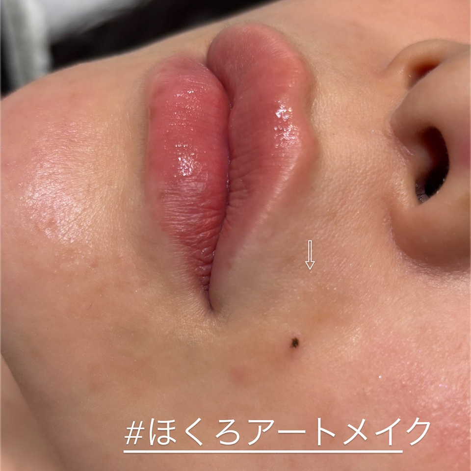 岩谷 ホクロアートメイク症例1
